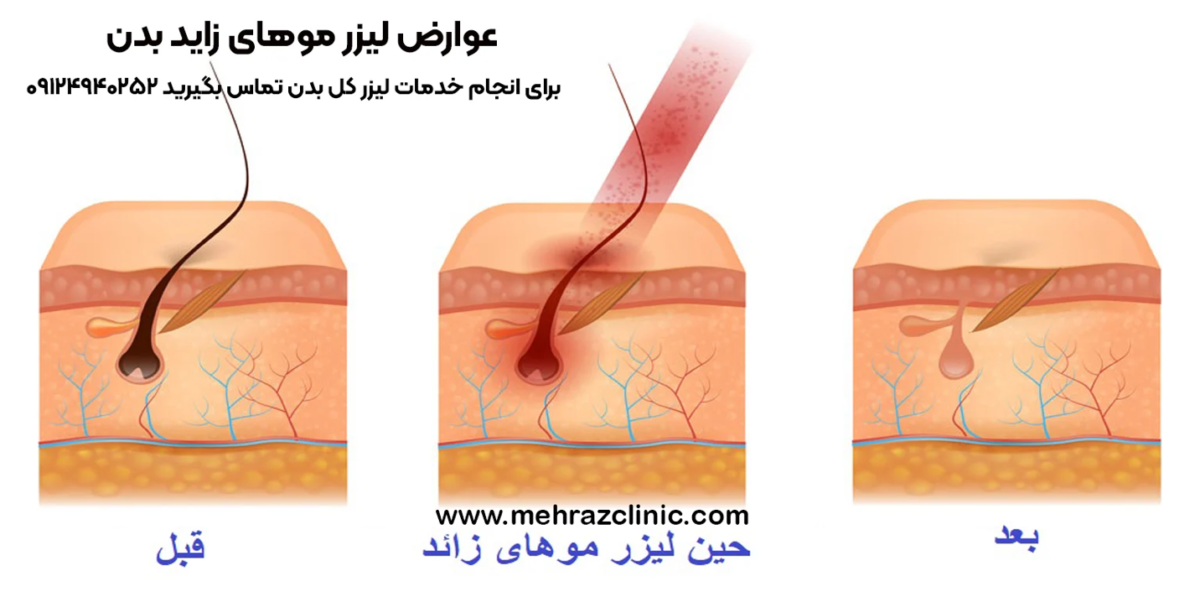 بهترین زمان شارژ لیزر موهای زائد برای از بین رفتن کامل موهای بدن