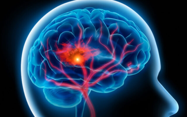 سکته مغزی چیست؟ علائم، علت و درمان انواع سکته مغزی