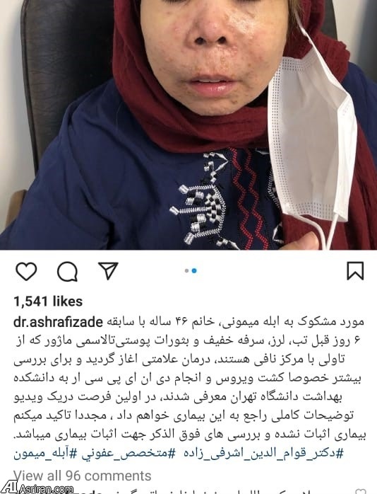 بیمار مشکوک به آبله میمون در ایران