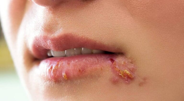 زونا - herpes zoster or shingles