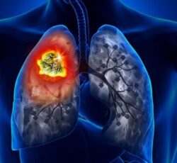 شدت آمفیزم با ریسک بالای ابتلا به سرطان ریه مرتبط است