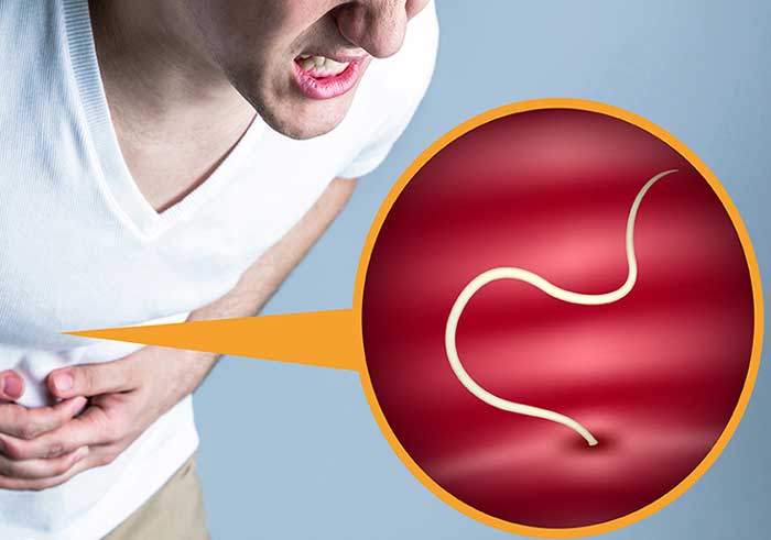 آسکاریازیس -Ascariasis
