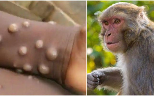 نشانه‌های ابتلا به آبله میمون / بررسی اثربخشی واکسن آبله