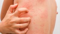 مشکلات پوستی آیا کهیر نشانه بیماری تیروئید است؟