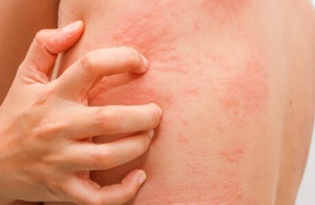 مشکلات پوستی  آیا کهیر نشانه بیماری تیروئید است؟