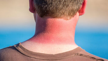 راه‌های تسکین درد ناشی از آفتاب سوختگی