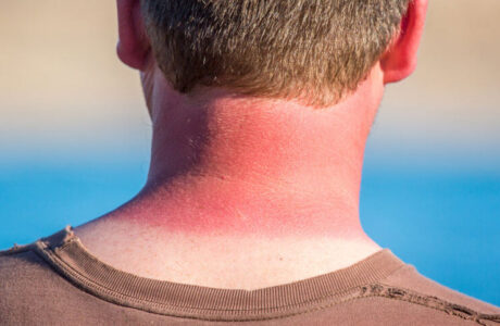 راه‌های تسکین درد ناشی از آفتاب سوختگی