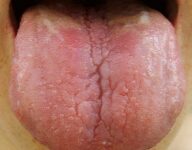 تشخیص بیماری ها از روی زبان