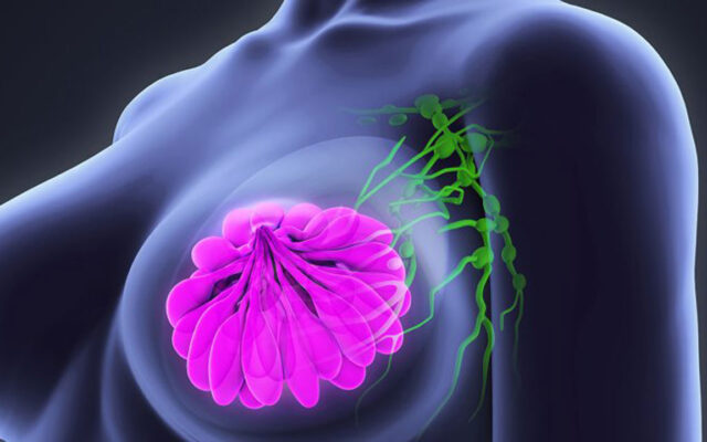 کشف دارویی که زندگی زنان مبتلا به سرطان پستان تهاجمی را افزایش می دهد