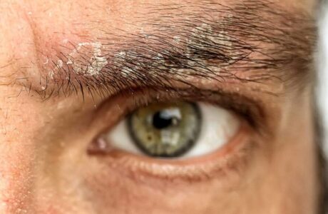 همه چیز درباره بیماری پوستی پسوریازیس
