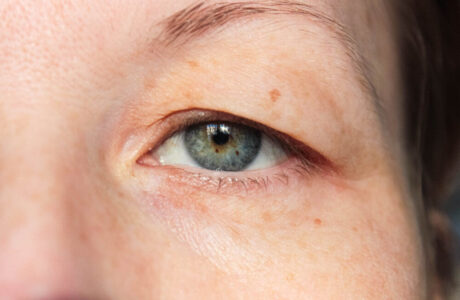علت افتادگی پلک چشم چیست و چطور درمان می‌شود؟