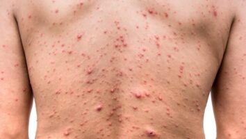 اگر آبله مرغان نگرفته اید، امکان ابتلا به زونا وجود دارد؟