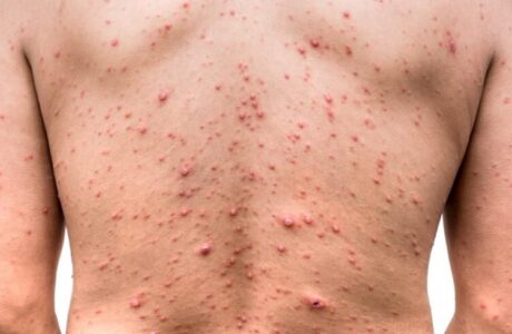 اگر آبله مرغان نگرفته اید، امکان ابتلا به زونا وجود دارد؟