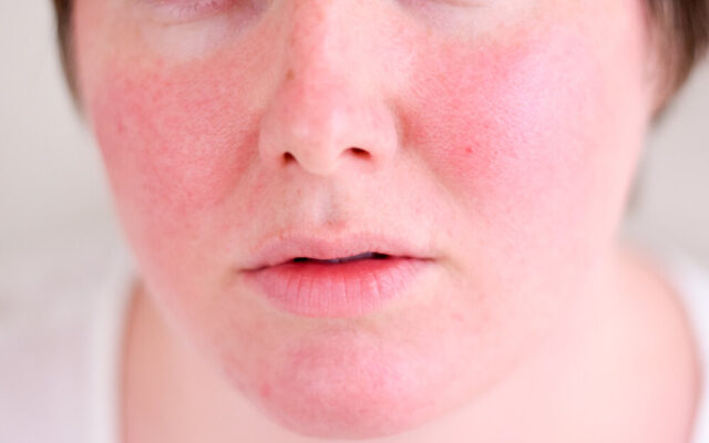 دلایل قرمز شدن ناگهانی پوست صورت و راه‌های درمان آن