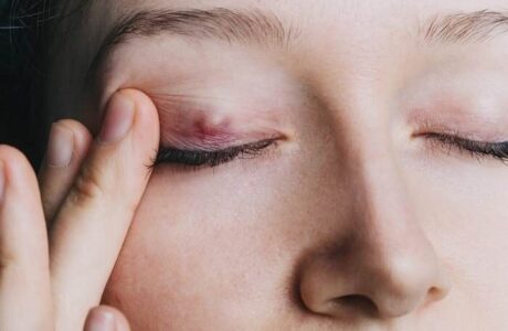 دلیل بروز گل مژه چیست؟
