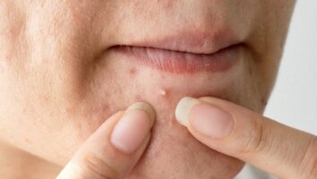 چرا فشردن جوش برای برخی رضایت بخش است؟