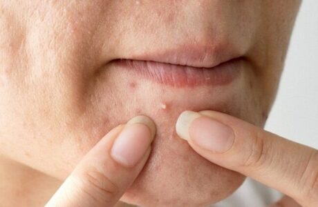 چرا فشردن جوش برای برخی رضایت بخش است؟