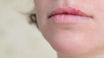 شایع‌ترین و خطرناک‌ترین بیماری های لب