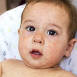 لکه‌های قرمز روی پوست کودکان نشانه‌ای از بیماری پلاکتی است