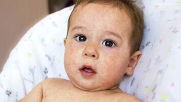 لکه‌های قرمز روی پوست کودکان نشانه‌ای از بیماری پلاکتی است