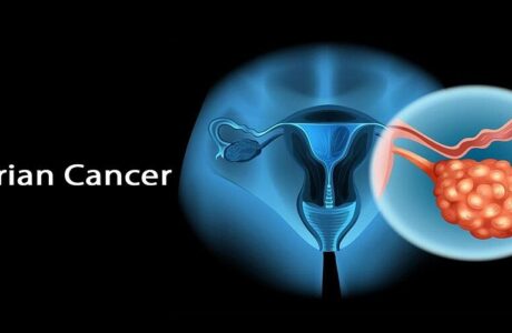 تغییرات قند، کلید اسرار سرطان تخمدان است