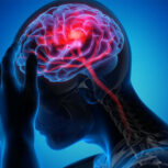 زمان طلایی برای مراجعه افراد دچار سکته مغزی به مراکز درمانی حداکثر ۶ ساعت است