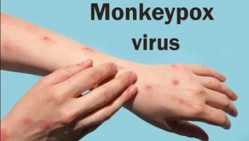 توصیه سازمان بهداشت جهانی برای پیشگیری از ابتلا به آبله میمونی