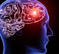 آنوریسم مغزی چیست و احتمال ابتلا به آن چقدر است؟