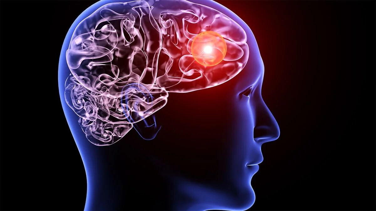 آنوریسم مغزی چیست و احتمال ابتلا به آن چقدر است؟