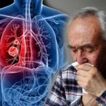 ۴ بیماری شایع ناشی از آلودگی هوا در کشور/ هزینه ۲۰۱ میلیون دلاری مرگ ناشی از سرطان ریه