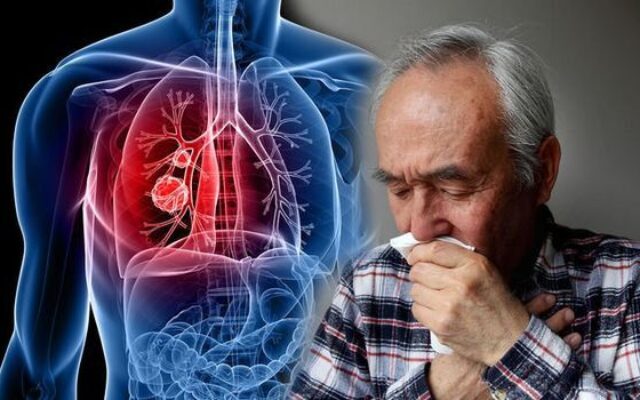 ۴ بیماری شایع ناشی از آلودگی هوا در کشور/ هزینه ۲۰۱ میلیون دلاری مرگ ناشی از سرطان ریه