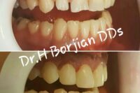 دکتر حسین برجیان بروجنی – دندانپزشک – ایمپلنت