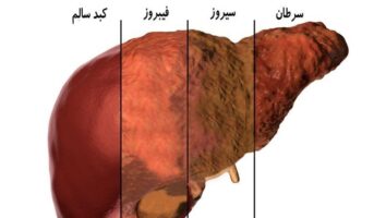 علل بیماری کبد چرب غیر الکلی