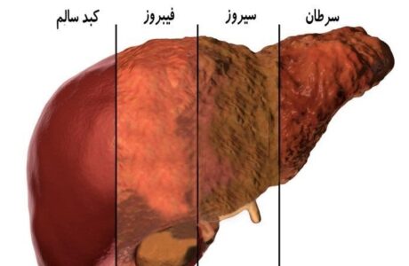 علل بیماری کبد چرب غیر الکلی