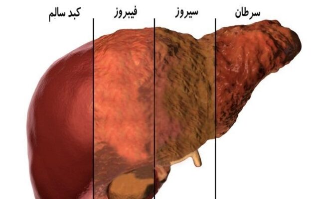 علل بیماری کبد چرب غیر الکلی