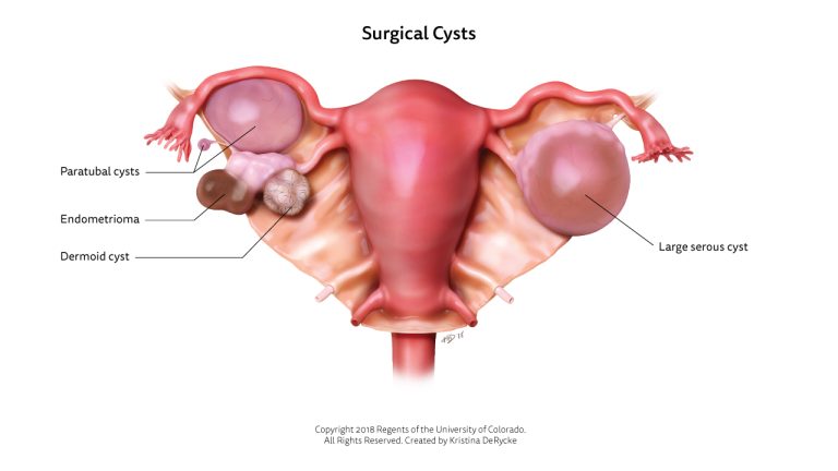 کیست تخمدان - Ovarian cyst