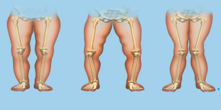 راشیتیسم - Rickets