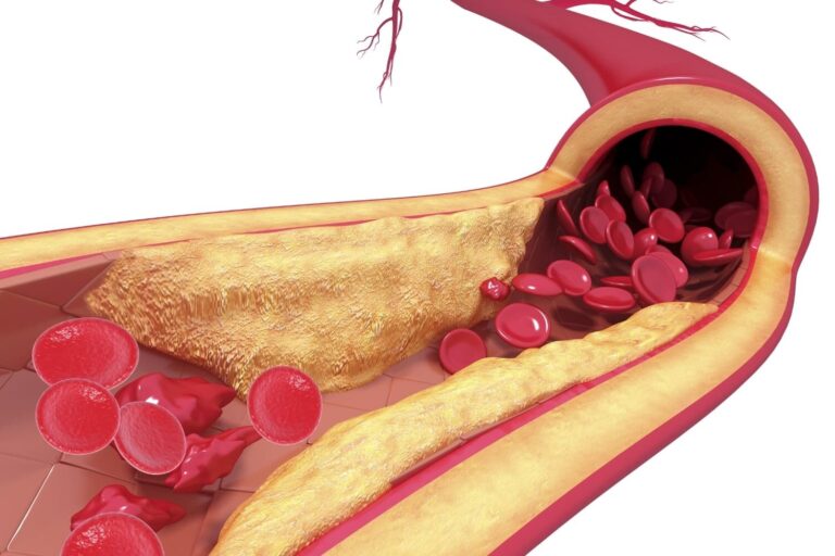 تصلب شرایین - Arteriosclerosis
