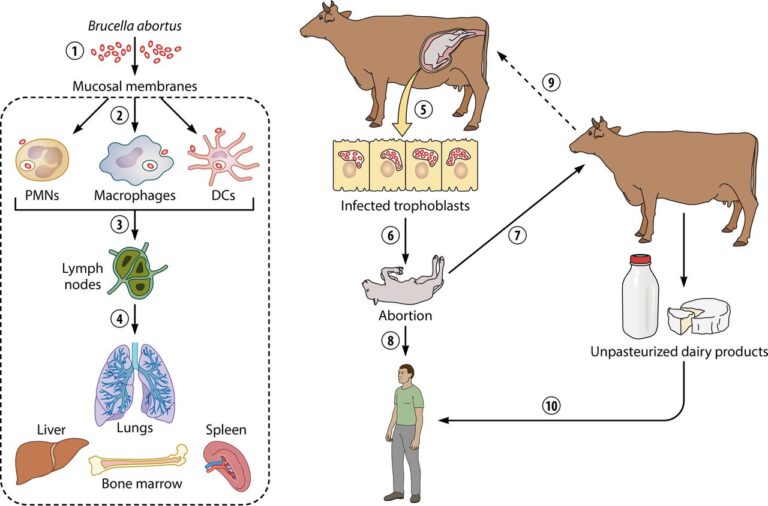 تب مالت - Brucellosis
