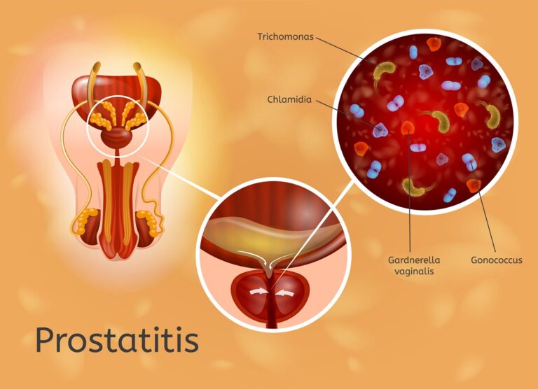 پروستاتیت - Prostatitis