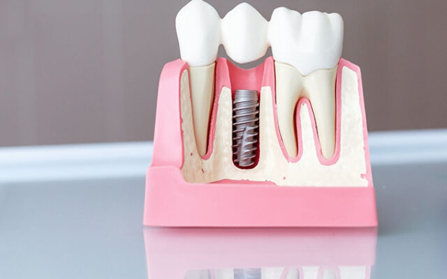 عمر ایمپلنت دندان چقدر است؟