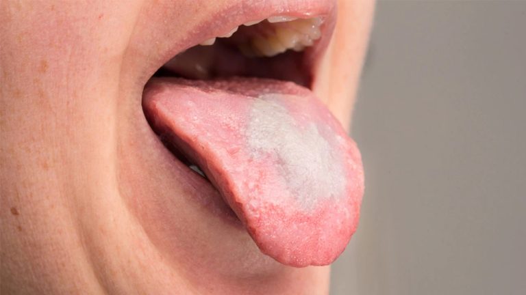 برفک دهان - Oral candidiasis