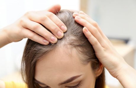 از ریزش موی سکه‌ای چه می‌دانید؟