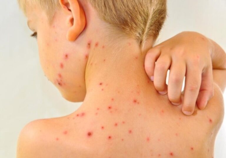 سرخک - Measles