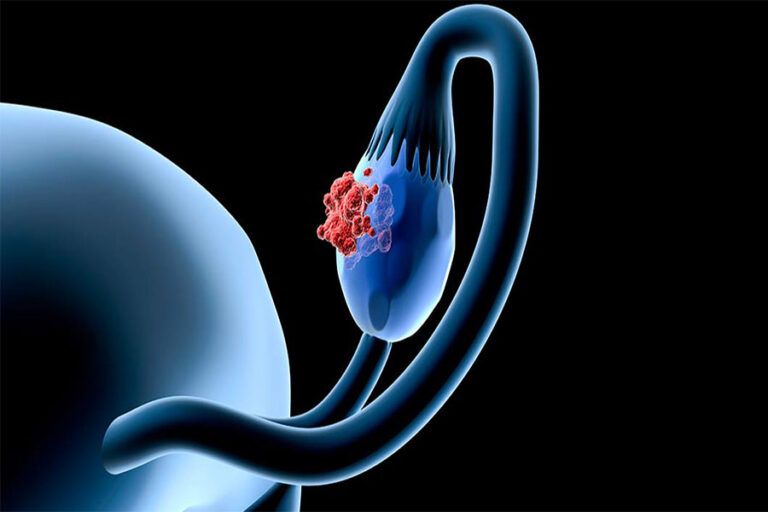 سرطان تخمدان - Ovarian cancer