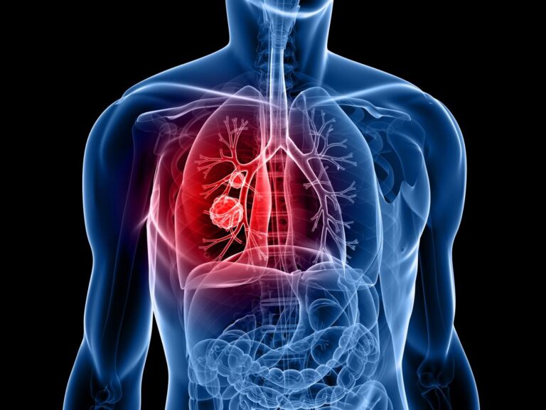 سرطان ریه - Lung cancer
