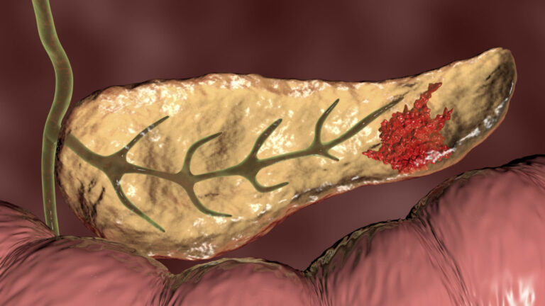 سرطان پانکراس - Pancreatic cancer