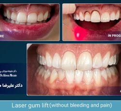 عصب کشی دندان با لیزر: نجات دوباره دندان عفونی شده