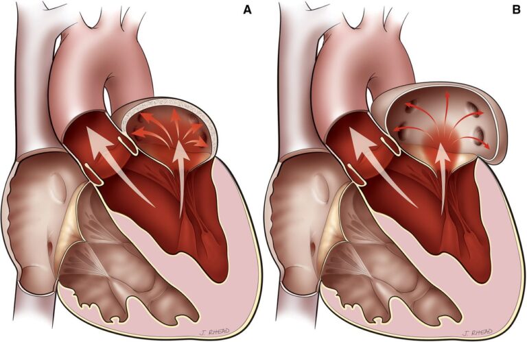 نارسایی دریچه میترال - Mitral regurgitation