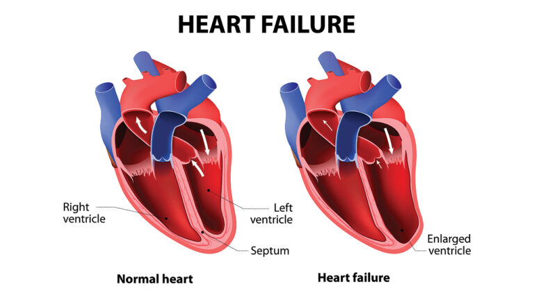 نارسایی قلب - Heart failure